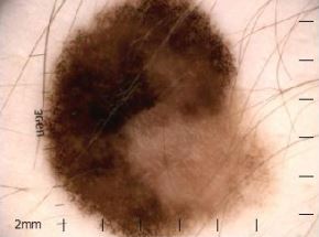 superficial spreading melanoma stage 1a breslow skin cancer